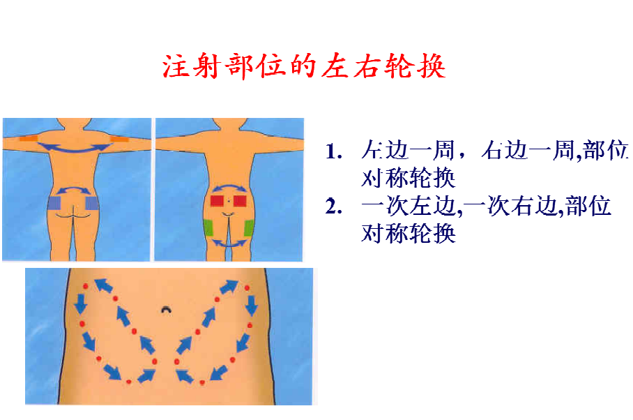 胰岛素注射部位图解