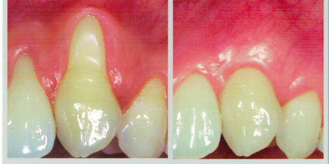 什么样的牙龈退缩能够通过手术治疗恢复正常