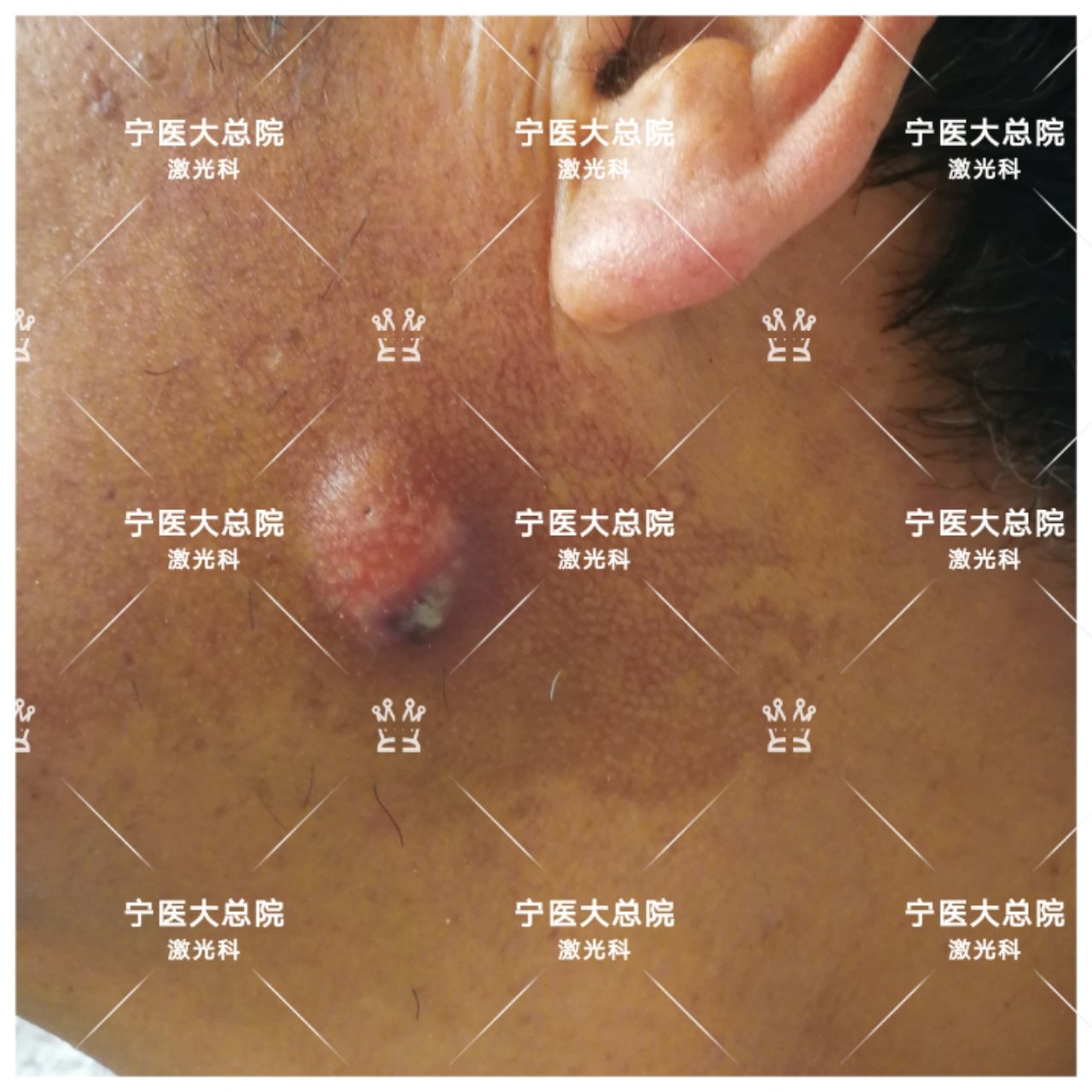 面部肿物切除 之 菱形皮瓣(一)