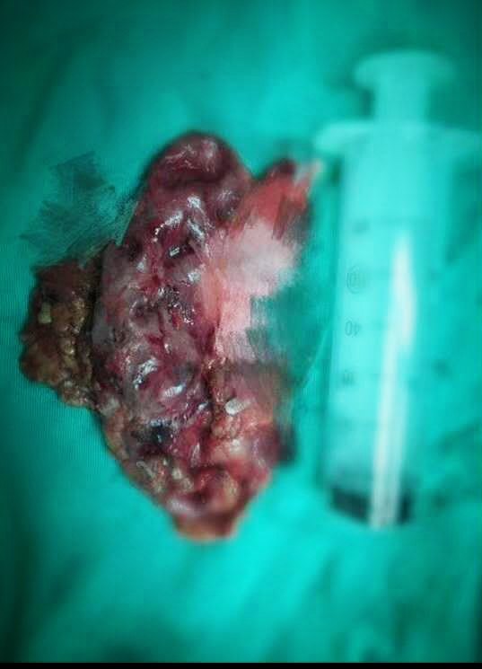 腹腔镜肾切除\/部分切除术(肿瘤性、无功能肾、