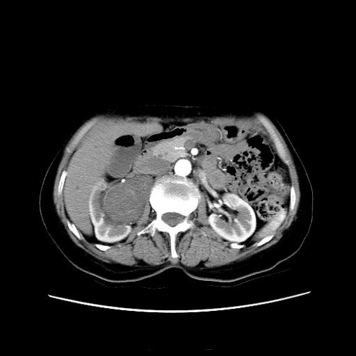 腹腔镜肾切除\/部分切除术(肿瘤性、无功能肾、