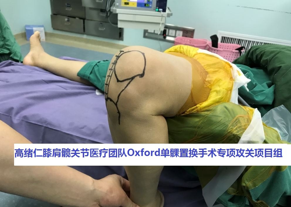 高绪仁:我们是怎么做oxford牛津单髁膝关节置换手术的