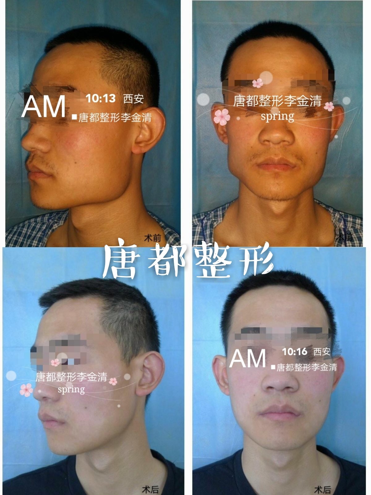 男性下颌骨截骨案例