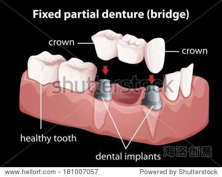 种植牙介绍(一)镶牙方式