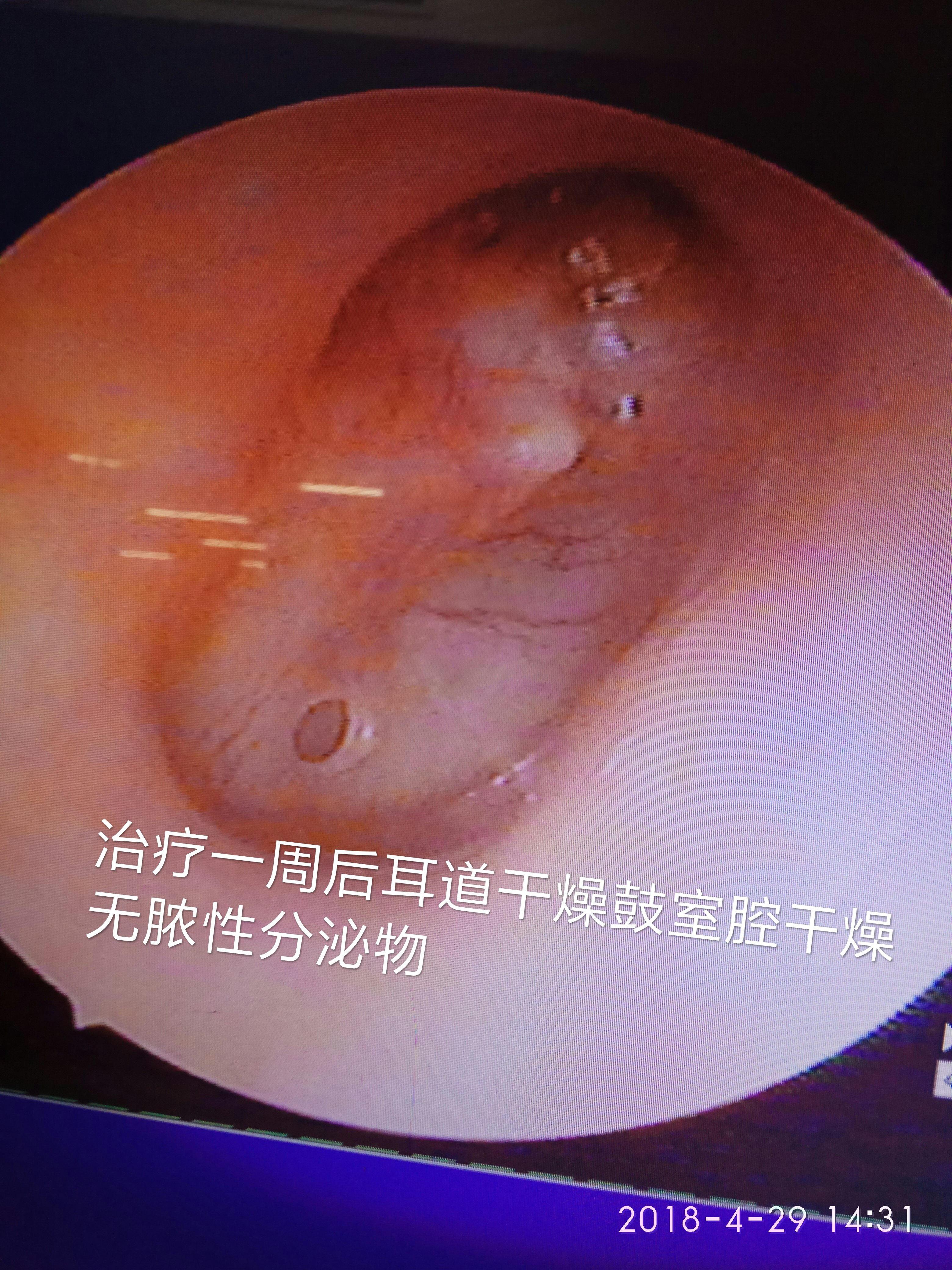 真菌性外耳道炎如何治疗?