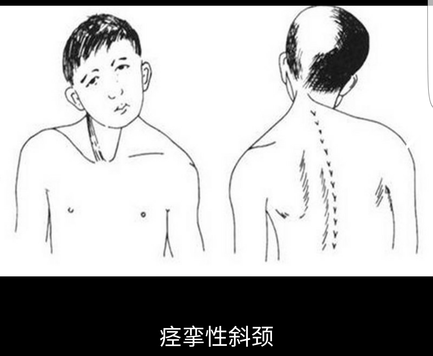 顺利完成一例痉挛性斜颈脑深部电刺激手术