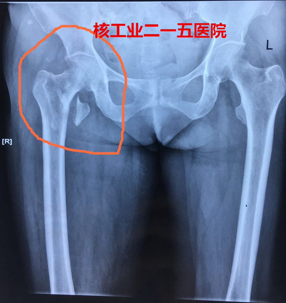股骨粗隆间骨折-内固定松动-关节置换术