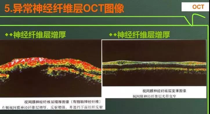 光学相干断层扫描(oct):清晰的显示眼后段主要是黄斑和视乳头的形态