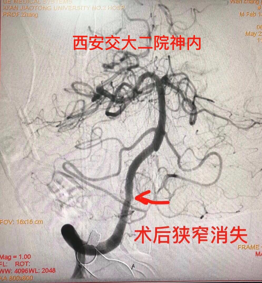基底动脉狭窄支架术