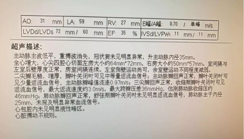 入院胸部ct及心脏b超示:全心扩大,射血分数仅有35%.