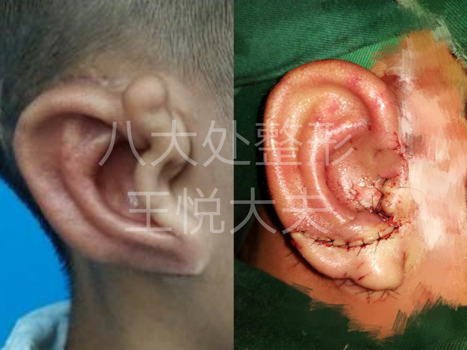 小耳再造手术典型病例照片持续更新中