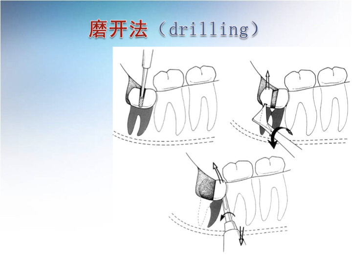 微创拔牙