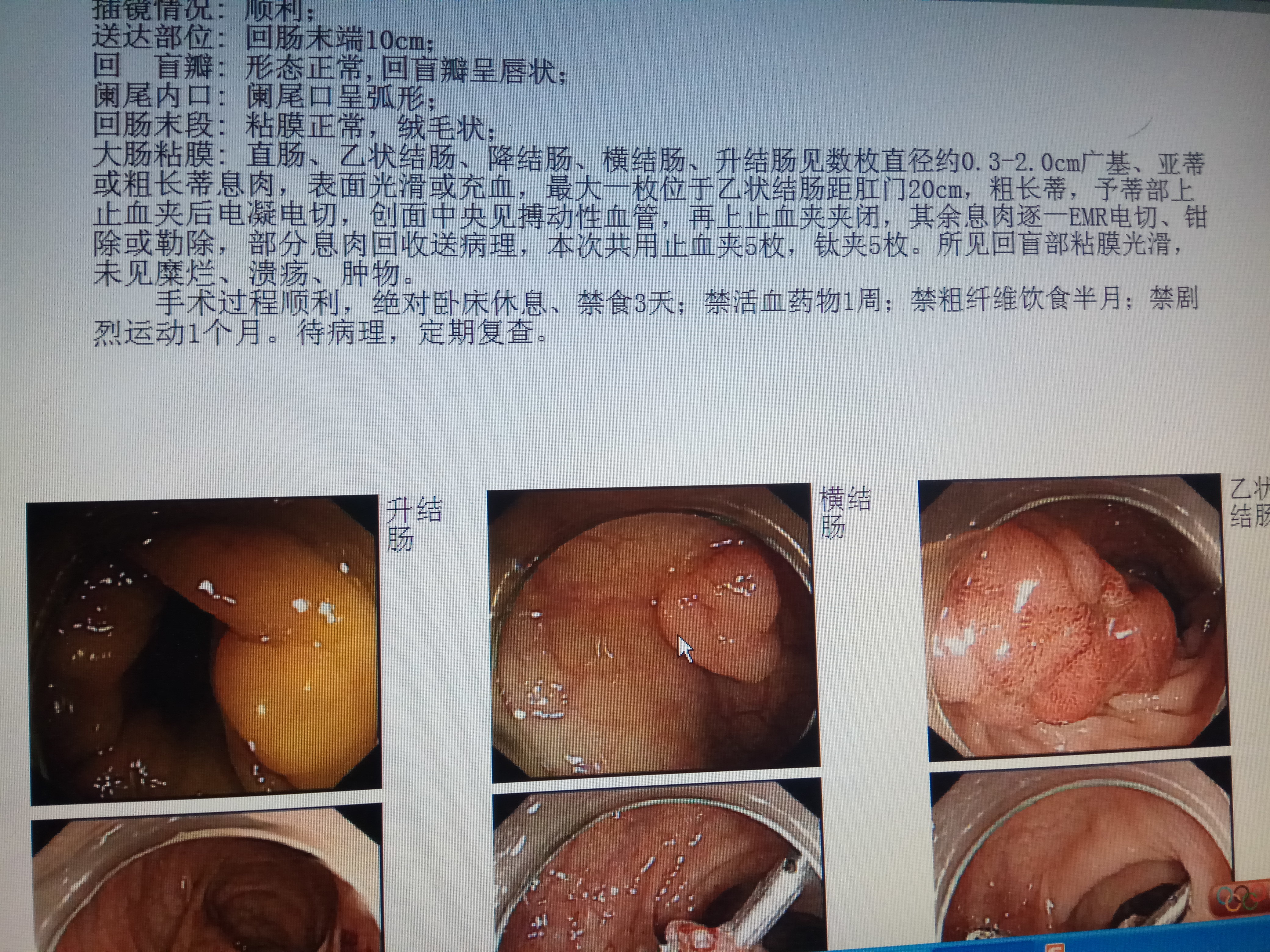 肛周脓肿行直乙肠镜病例分享