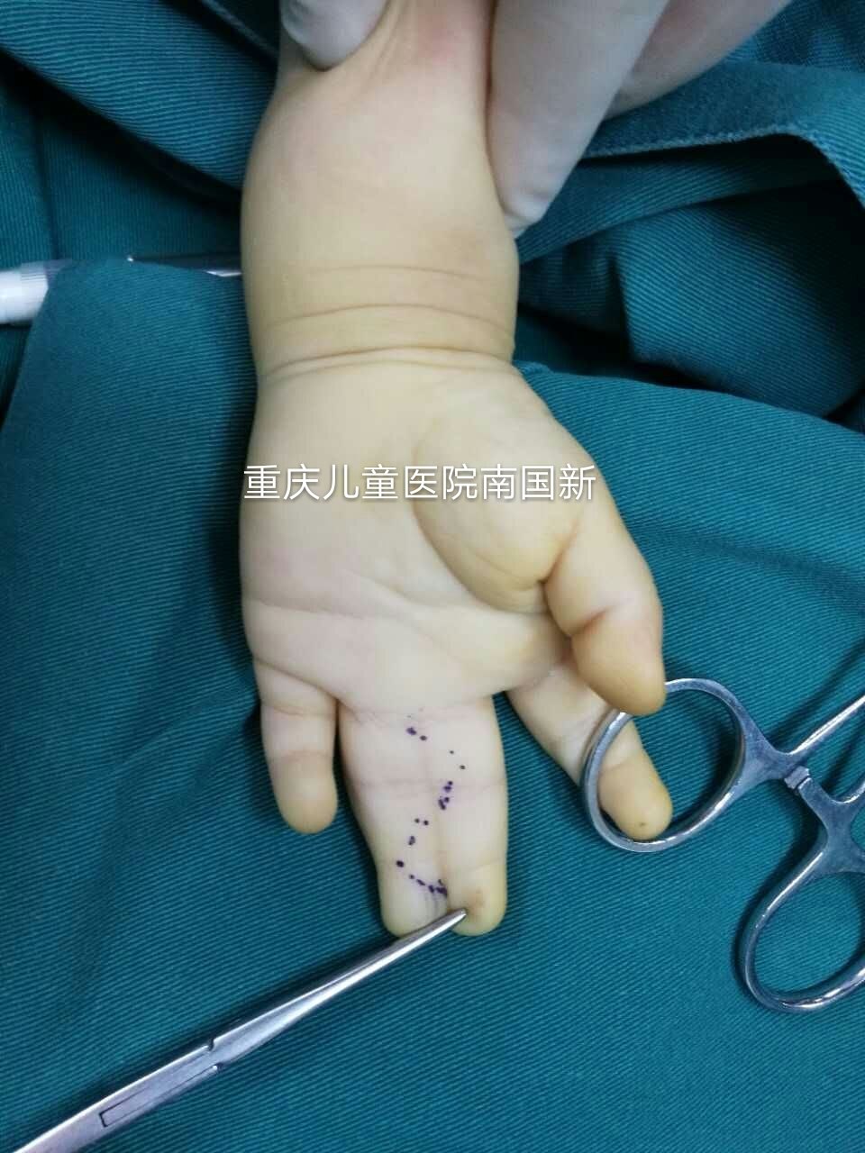 并指分离手术