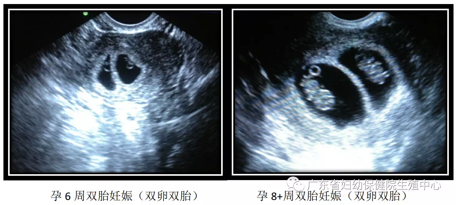 卵黄囊及胚芽,则为双胎或多胎妊娠也就是早期宝宝的形态,早期超声可见