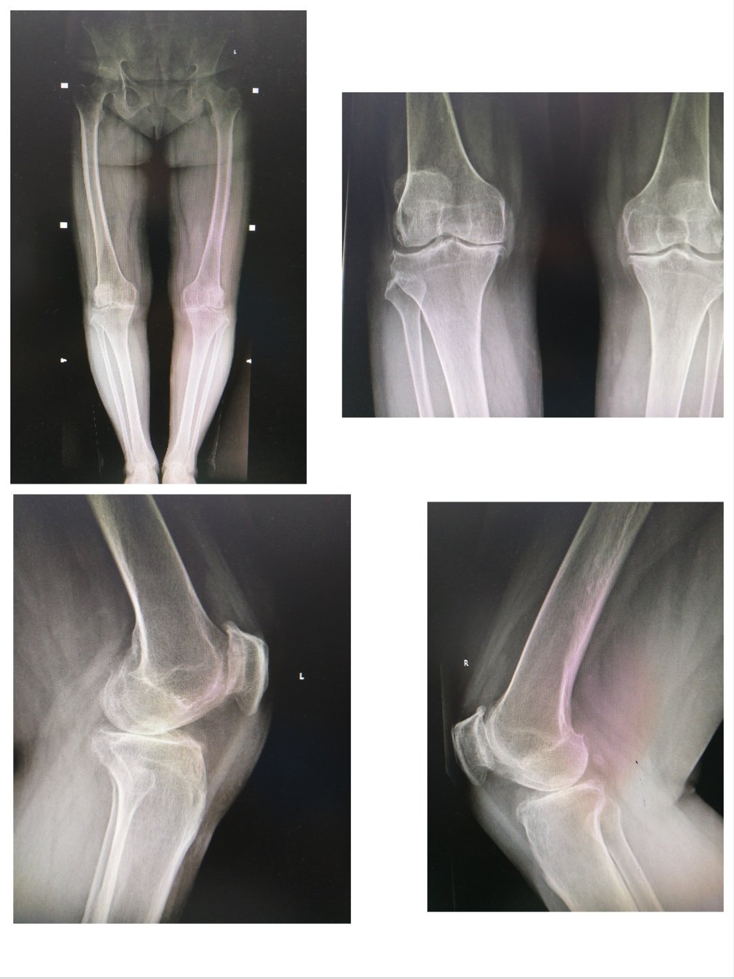1.x线在膝关节的损伤中常用的检查目的在于