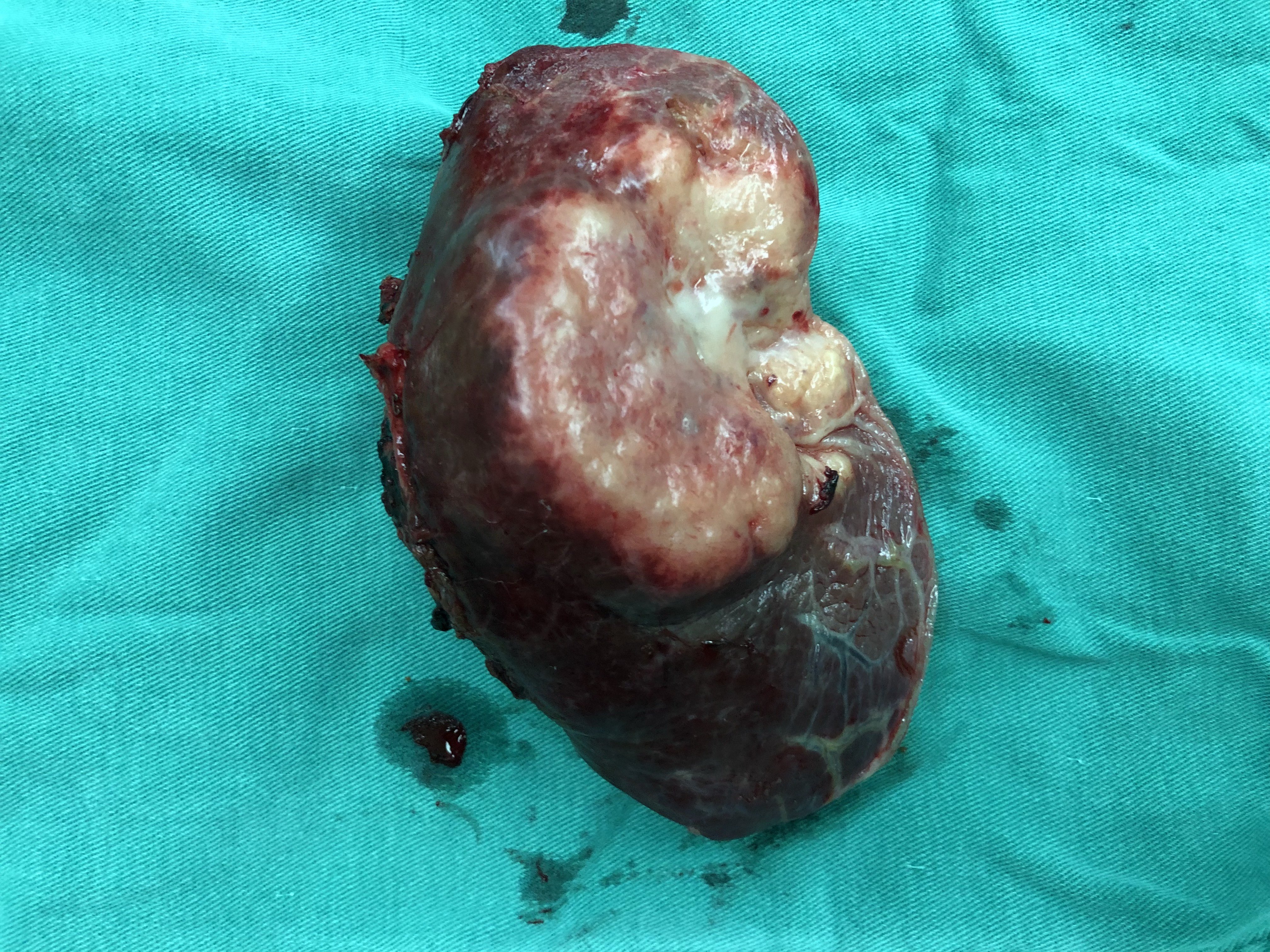 腹腔镜左肝外叶切除术治疗肝胆管细胞癌一例
