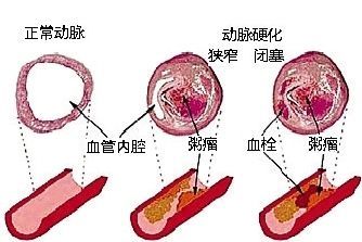 粥样硬化5B14197.jpg