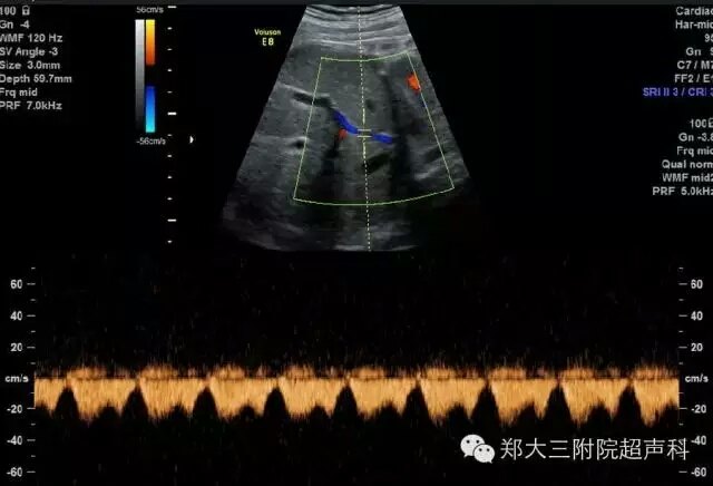 静脉导管a波反向脐静脉搏动