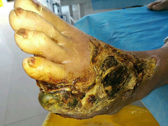 创面干性坏死,感觉自己身体情况太差了