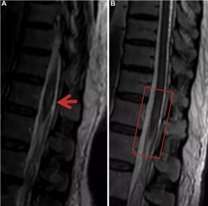 硬脊膜动静脉瘘你可能漏诊的脊髓损害
