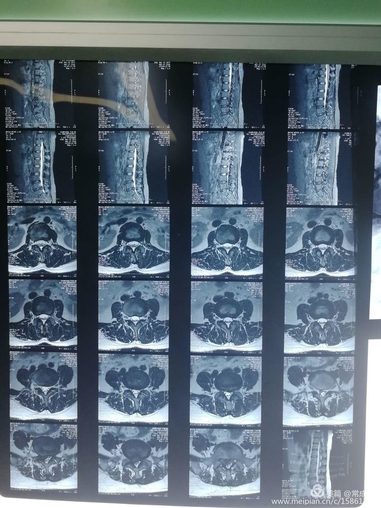 术前mri轴位示:腰5~骶1间盘右侧脱出,压迫硬膜囊!