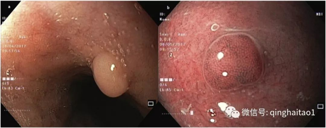 胃底腺息肉可能是单个或多个,通常位于胃体和胃底.胃底腺息肉可能是