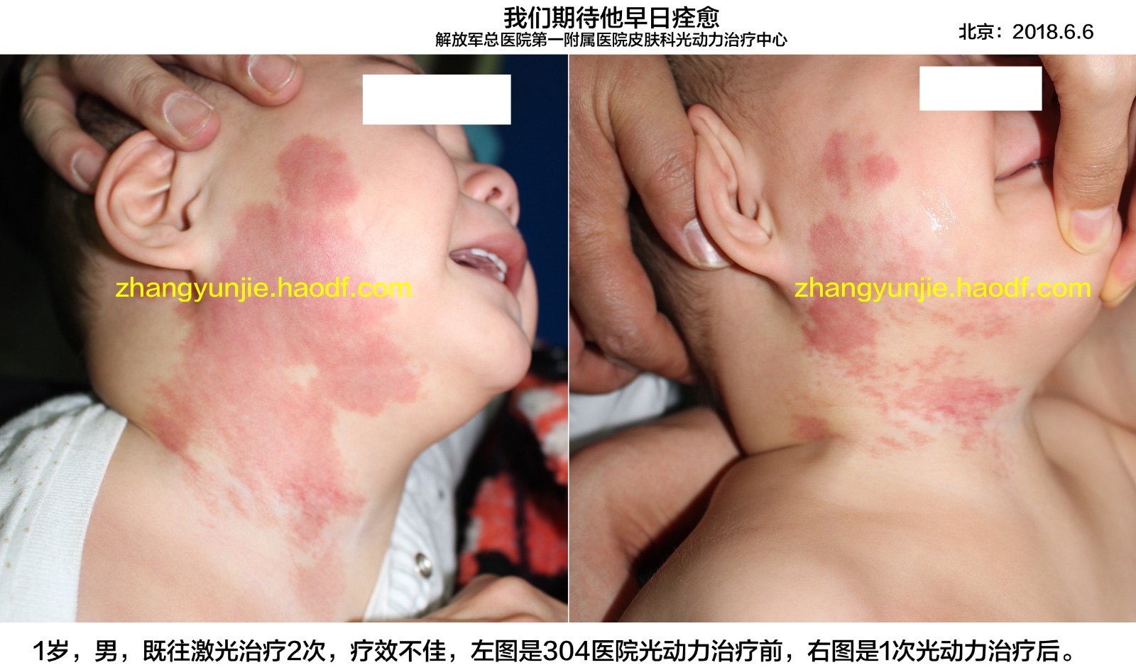 光动力治疗幼儿鲜红斑痣