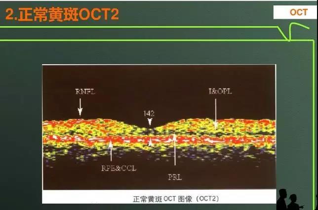 眼科新手必读:oct结果解读