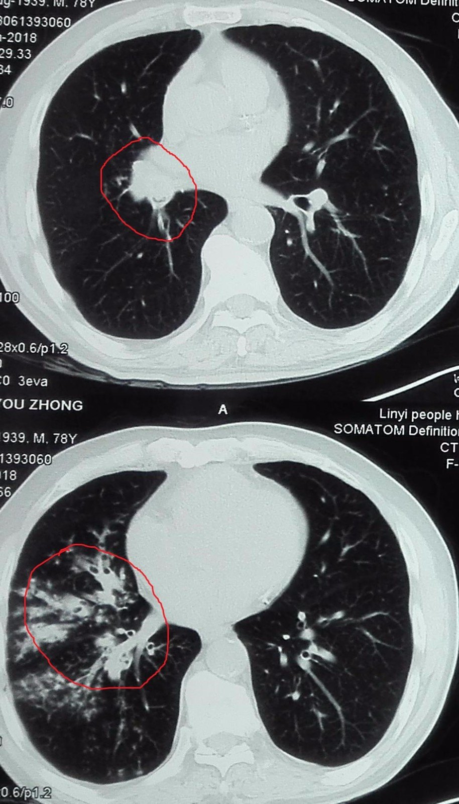 肺癌---管腔内癌,阻塞性肺炎(支气管镜诊断)