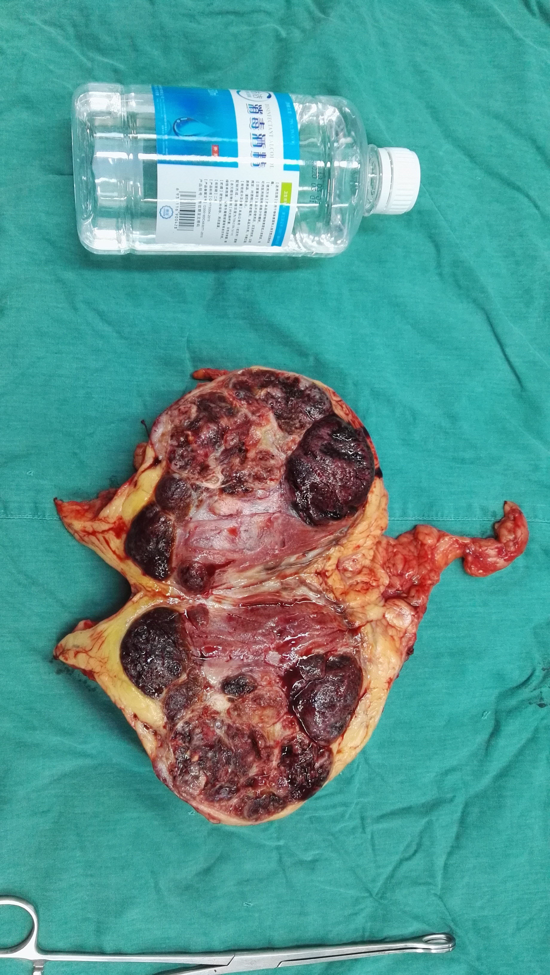 病例1,巨大肾脏肿瘤切开后的剖面.病例2,巨大肾脏肿瘤21公分大小.