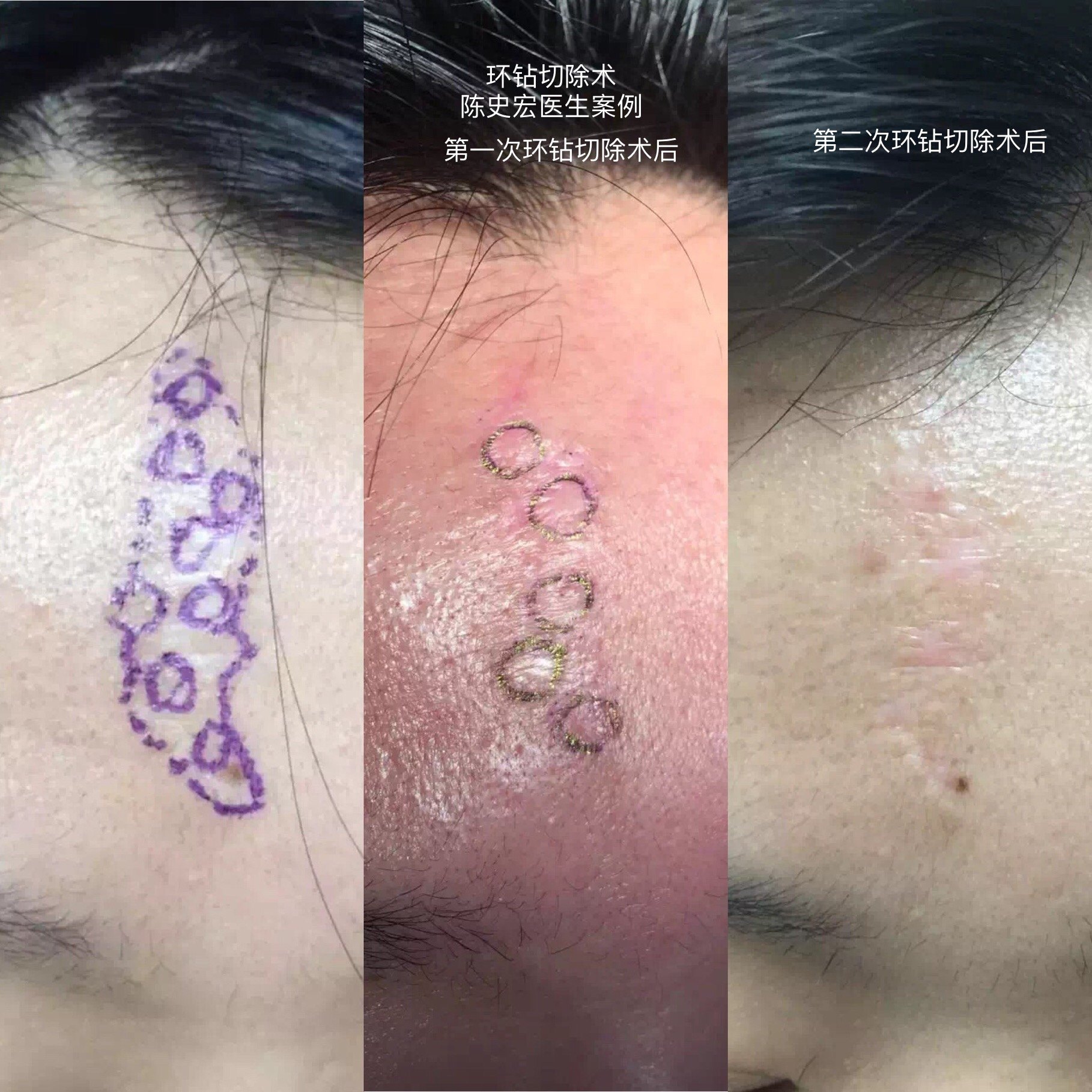 缝合 环钻切除术联合精细缝合也可以用于外伤瘢痕的分次微创手术治疗