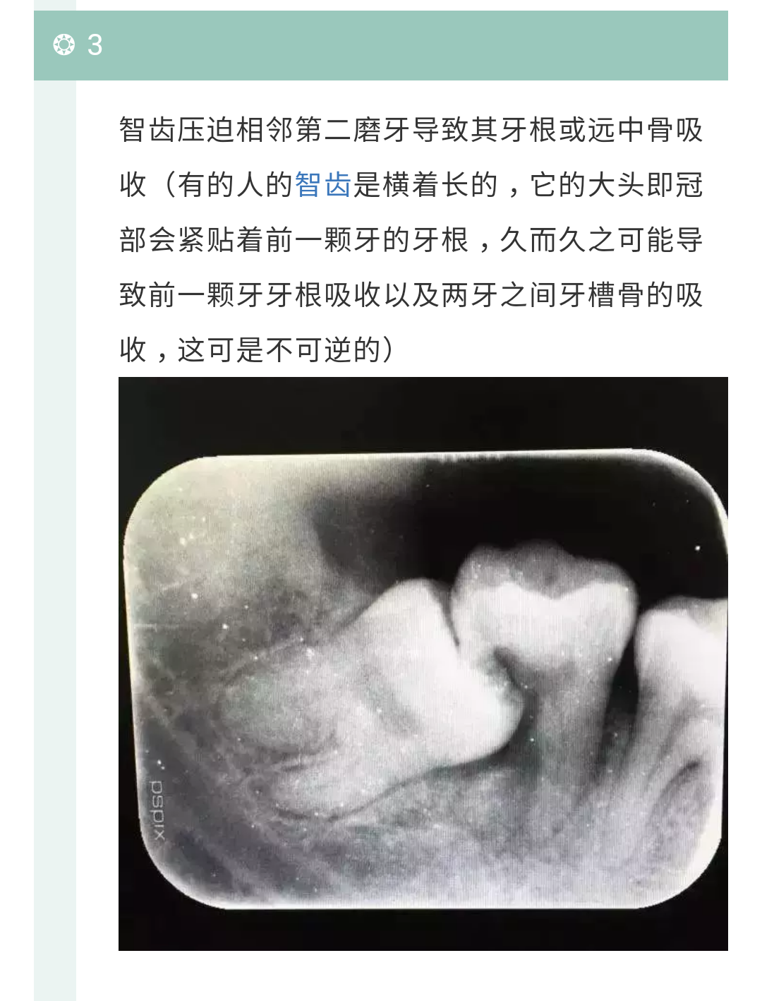 以上列举常见几种需要拔除智齿的情况,建议专科医院就诊咨询,或者给我