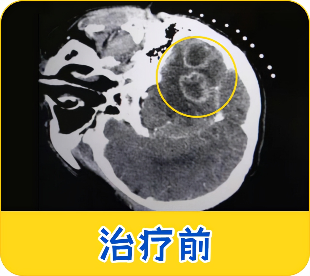 59岁肺癌脑转移肿瘤介入科碘125粒子植入显威力