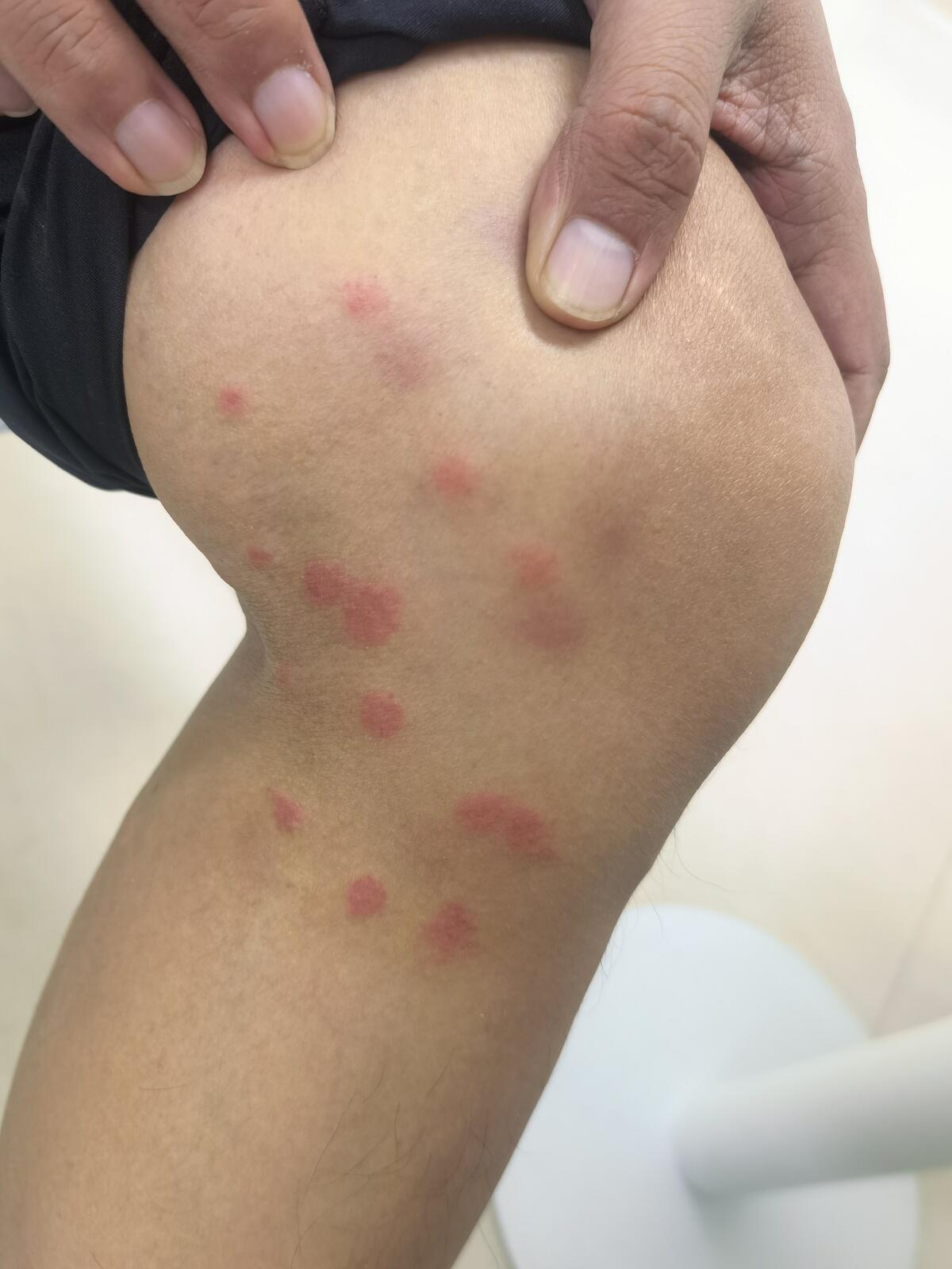 引起瘙痒不适主要是蚊虫注入皮肤的体液等过敏所致;一,虫咬皮炎是什么