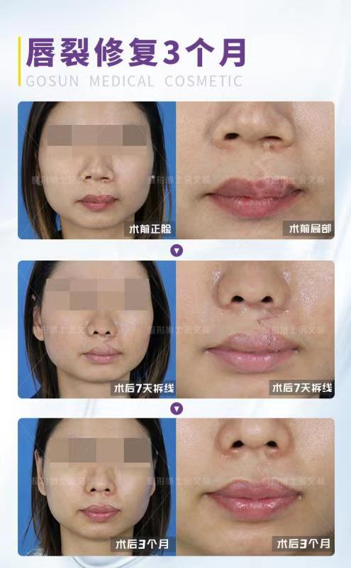 单侧唇裂有明显疤痕怎么办来看看三个月复查案例