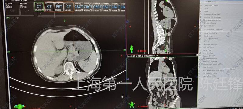 pet/ct示:贲门癌伴淋巴结转移可能,患者年龄大,拒绝手术.