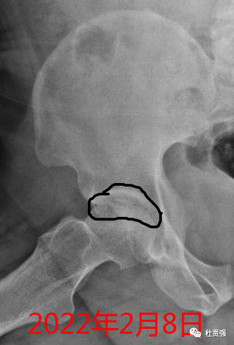 股骨头坏死的新月征