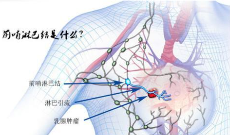 那么问题来了:我们如何在不进行腋窝淋巴结清扫的