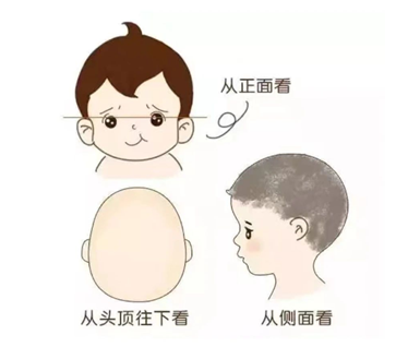 婴幼儿位置性头颅畸形科普之三鉴别