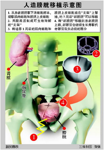 美国成功实施全球首次人造膀胱移植术