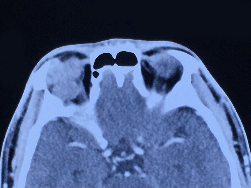 泪腺恶性肿瘤之腺样囊性癌