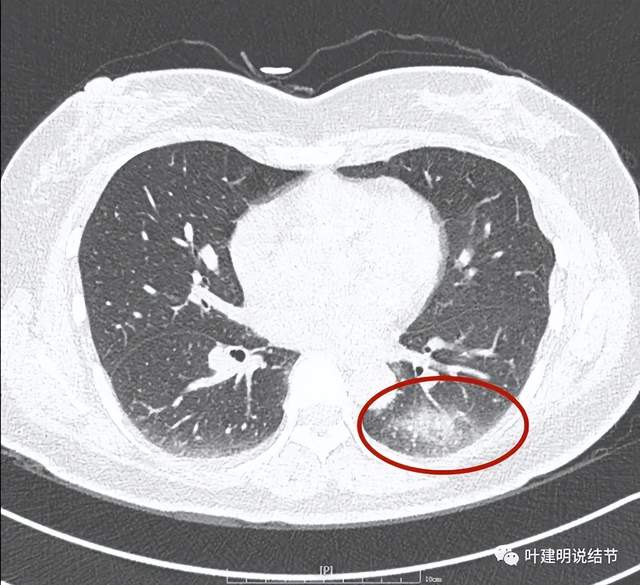 疑难也是两难的肺多发结节病例我们该如何来进行临床决策分析从而对