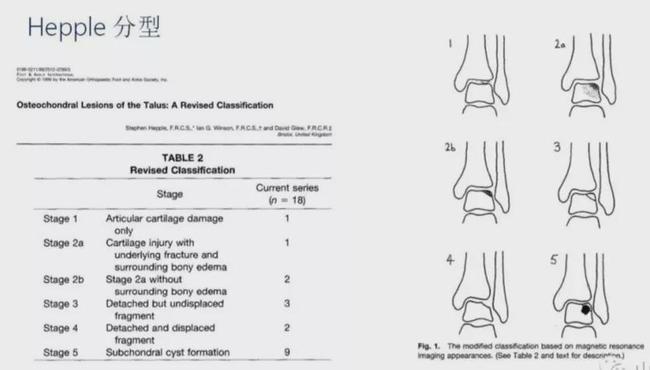 踝关节疼痛不可忽视的踝关节骨软骨损伤