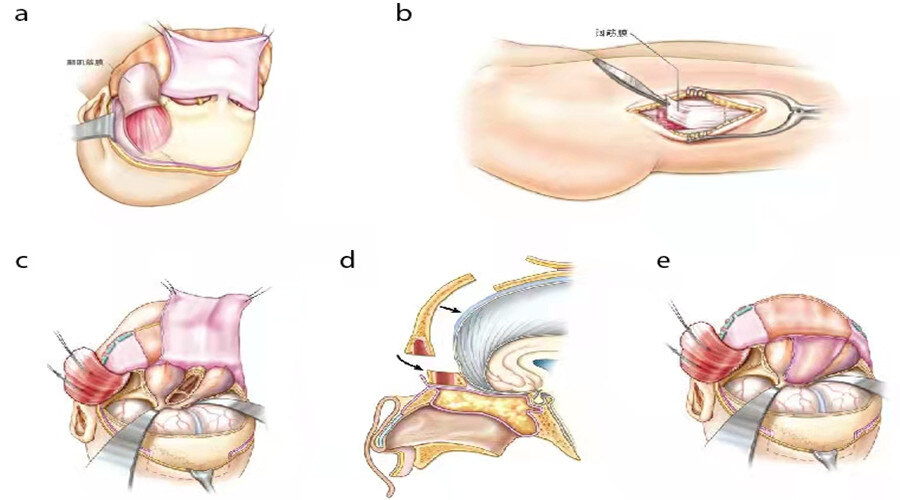 颅底重建:取自体(a)颞肌筋膜(b)阔筋膜和(c)额部骨膜组织修补硬膜(d