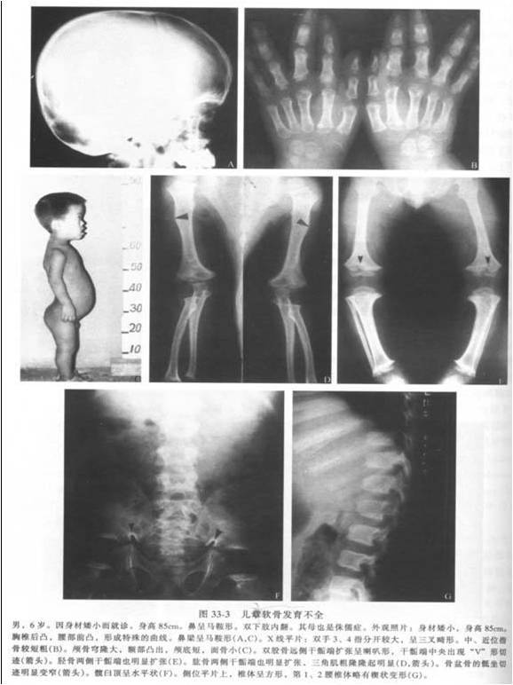 正确认识和了解软骨发育不全
