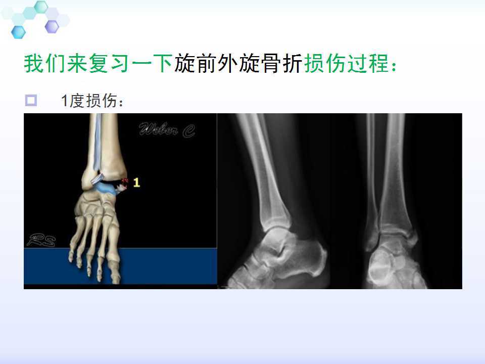 踝关节旋前外旋4度损伤病例讨论