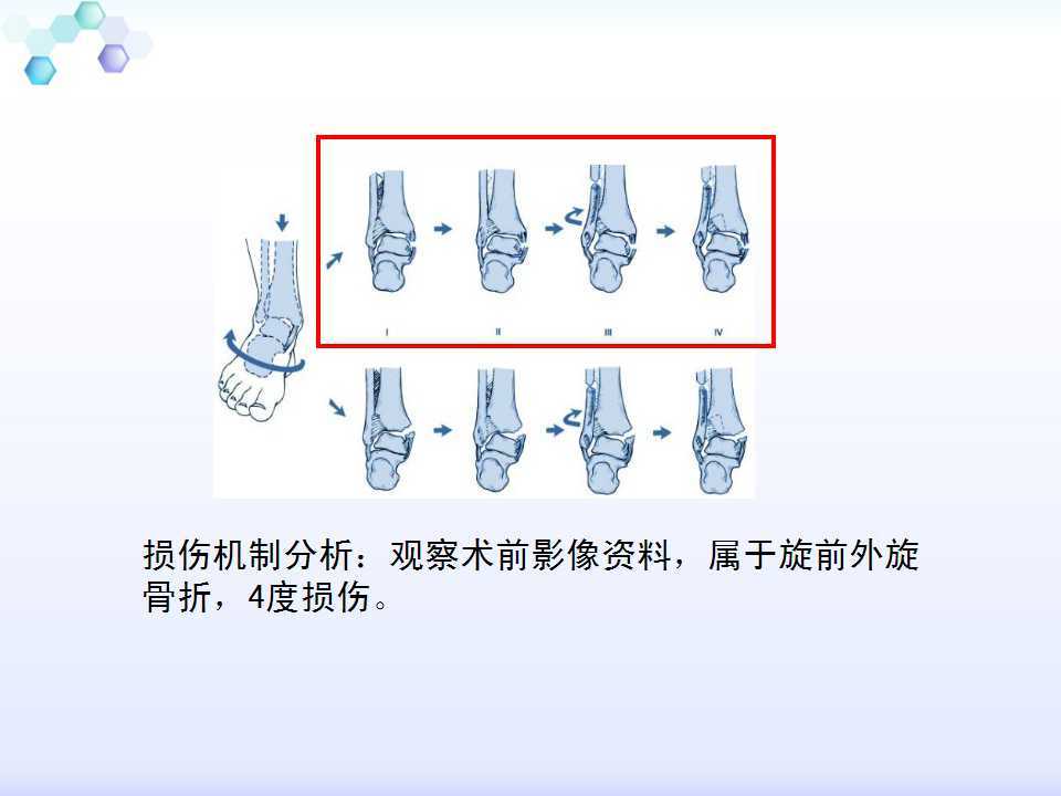 踝关节旋前外旋4度损伤病例讨论