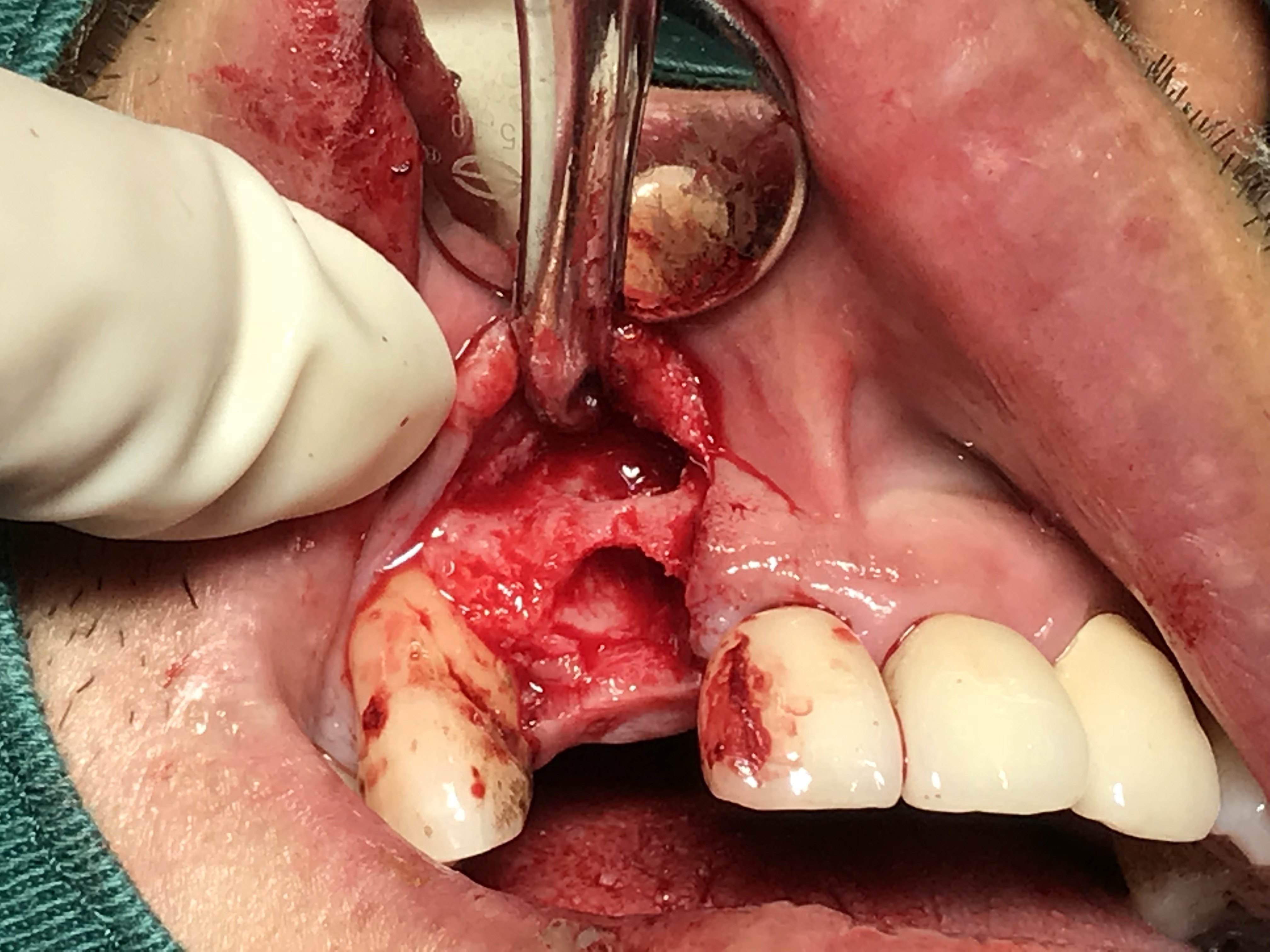 上颌前牙根尖囊肿摘除即刻种植一例