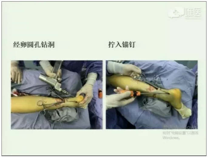 手术技巧卵圆钳引线法修复闭合性跟腱损伤